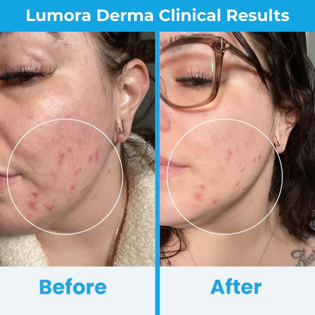 Lumora High Frequency Wand