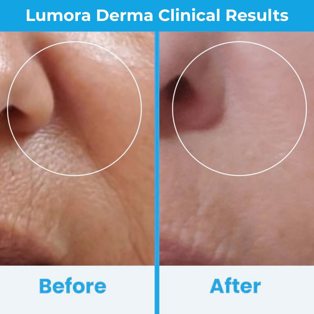 Lumora High Frequency Wand